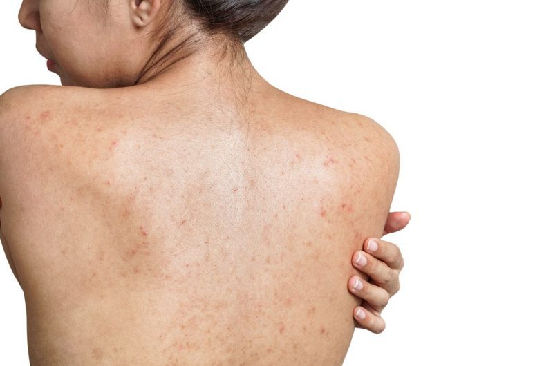 Astuces éliminer acné dans le dos